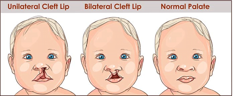 عملية الشفة الأرنبية Cleft lip and cleft palate