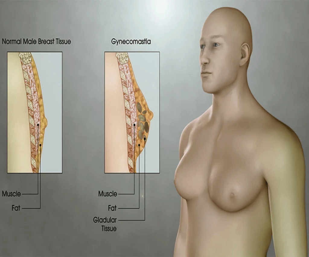 التثدي Gynecomastia