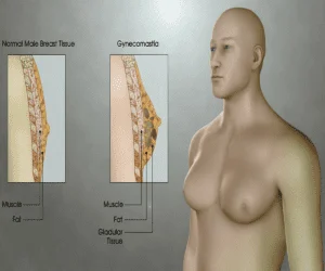 التثدي Gynecomastia