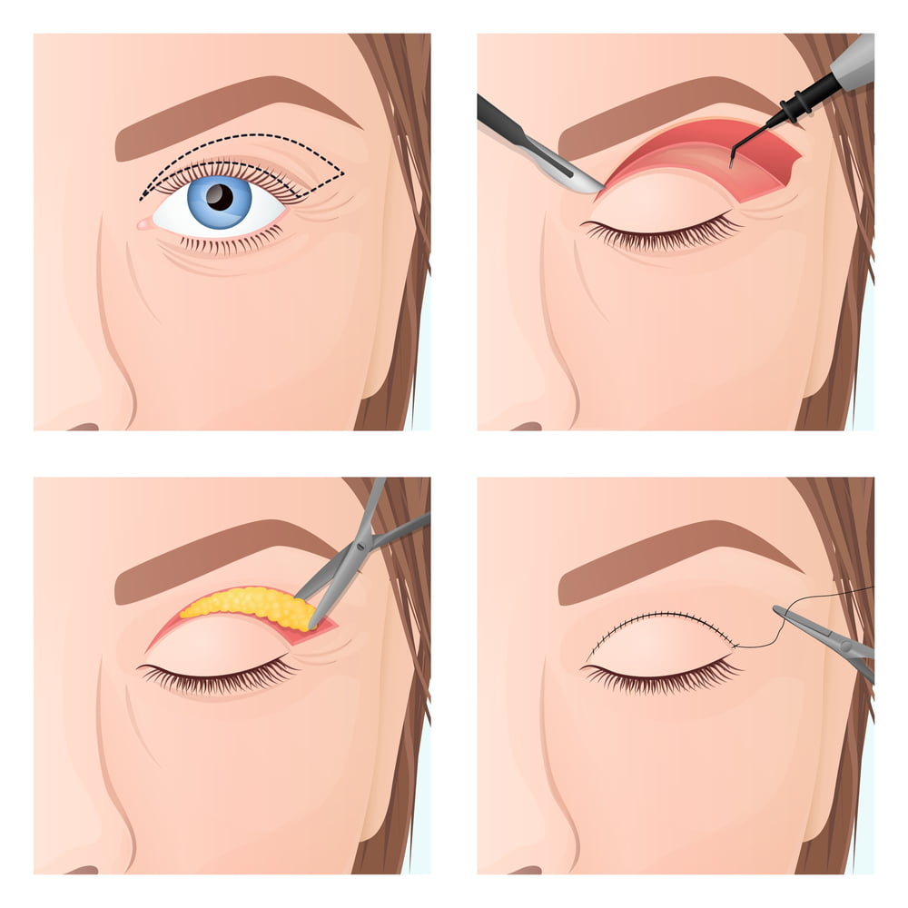 تجميل الجفنين Blepharoplasty