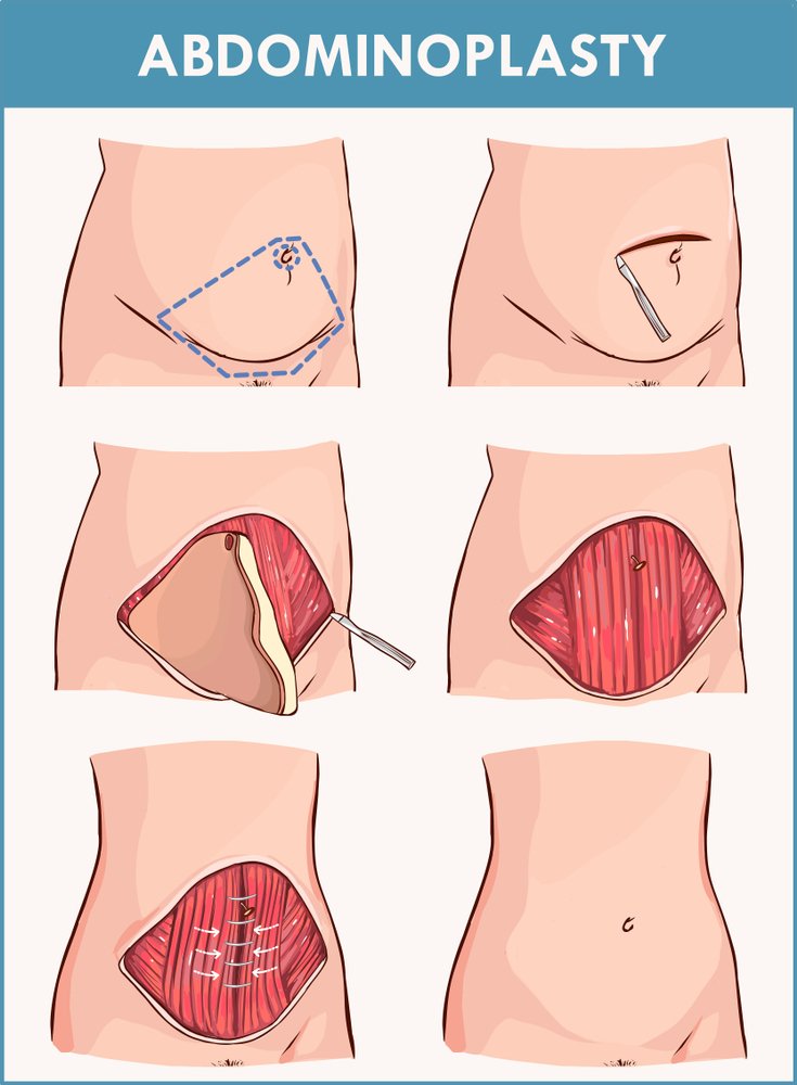 شد البطن الجراحي Surgical tummy tuck