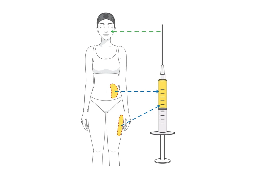 fat injection
