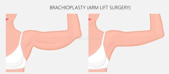 Arm lift