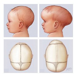 تعظم الدروز الباكر Craniosynostosis