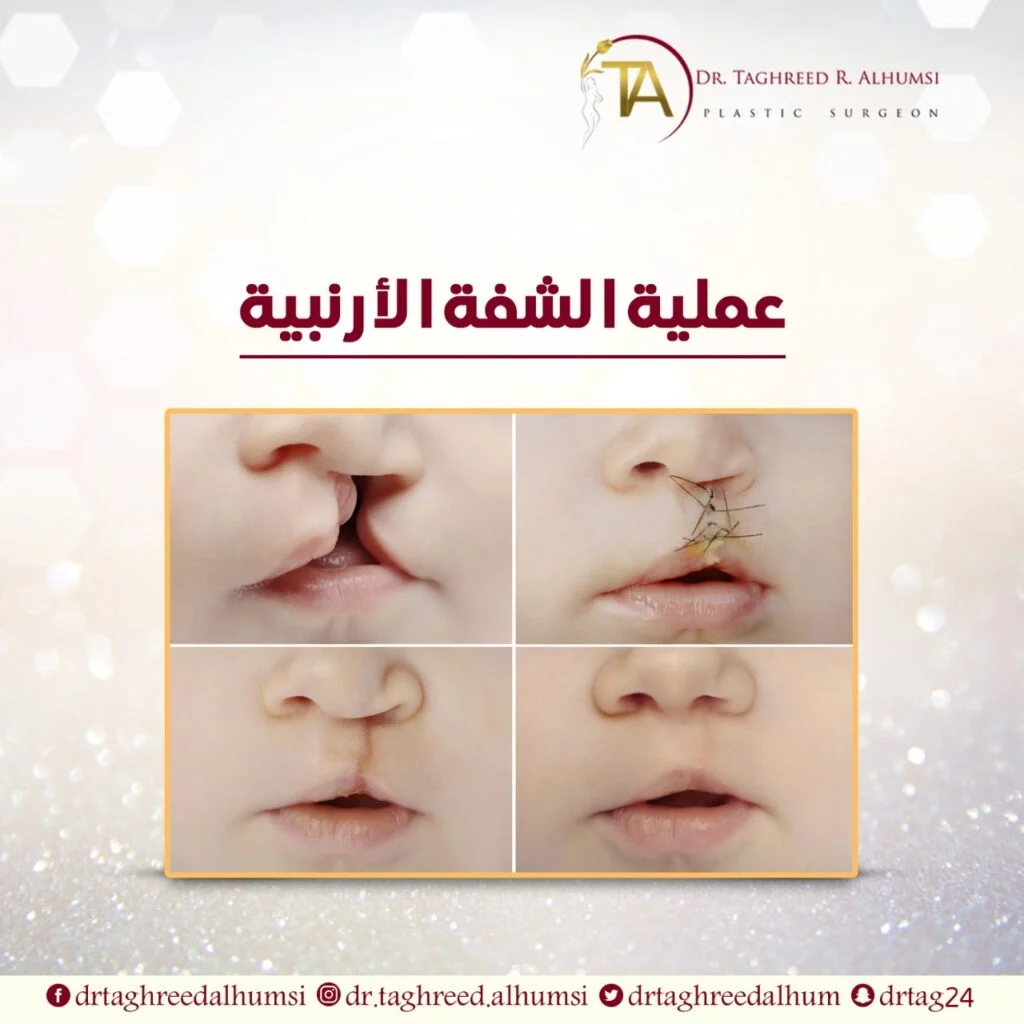 عملية الشفة الأرنبية