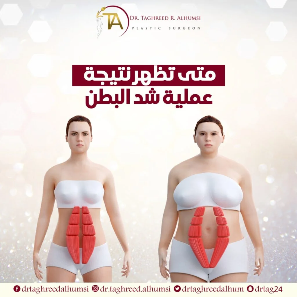 متى تظهر نتيجة عملية شد البطن