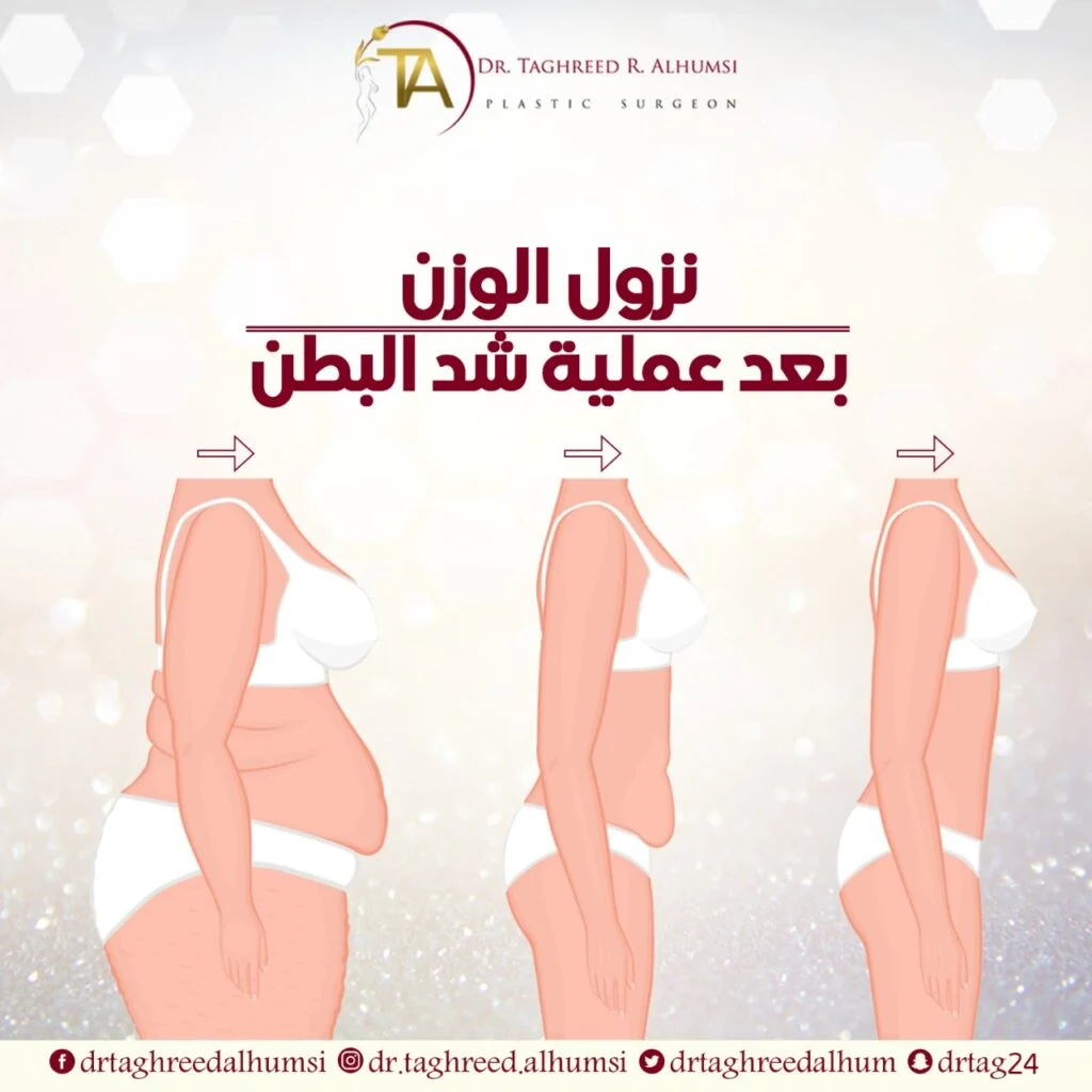 كل ما يخص نزول الوزن بعد عملية شد البطن