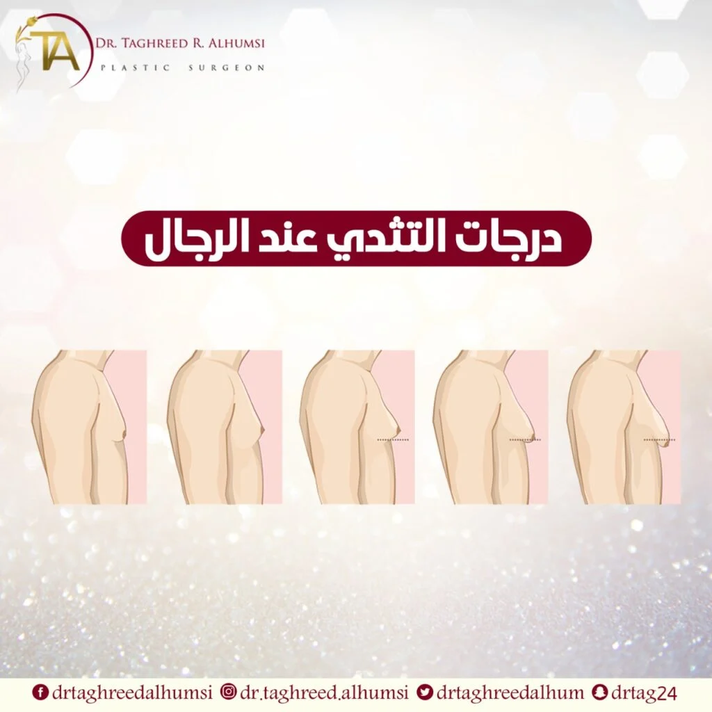درجات التثدي عند الرجال