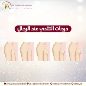 درجات التثدي عند الرجال