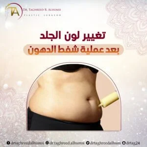 تغير لون الجلد بعد عملية شفط الدهون