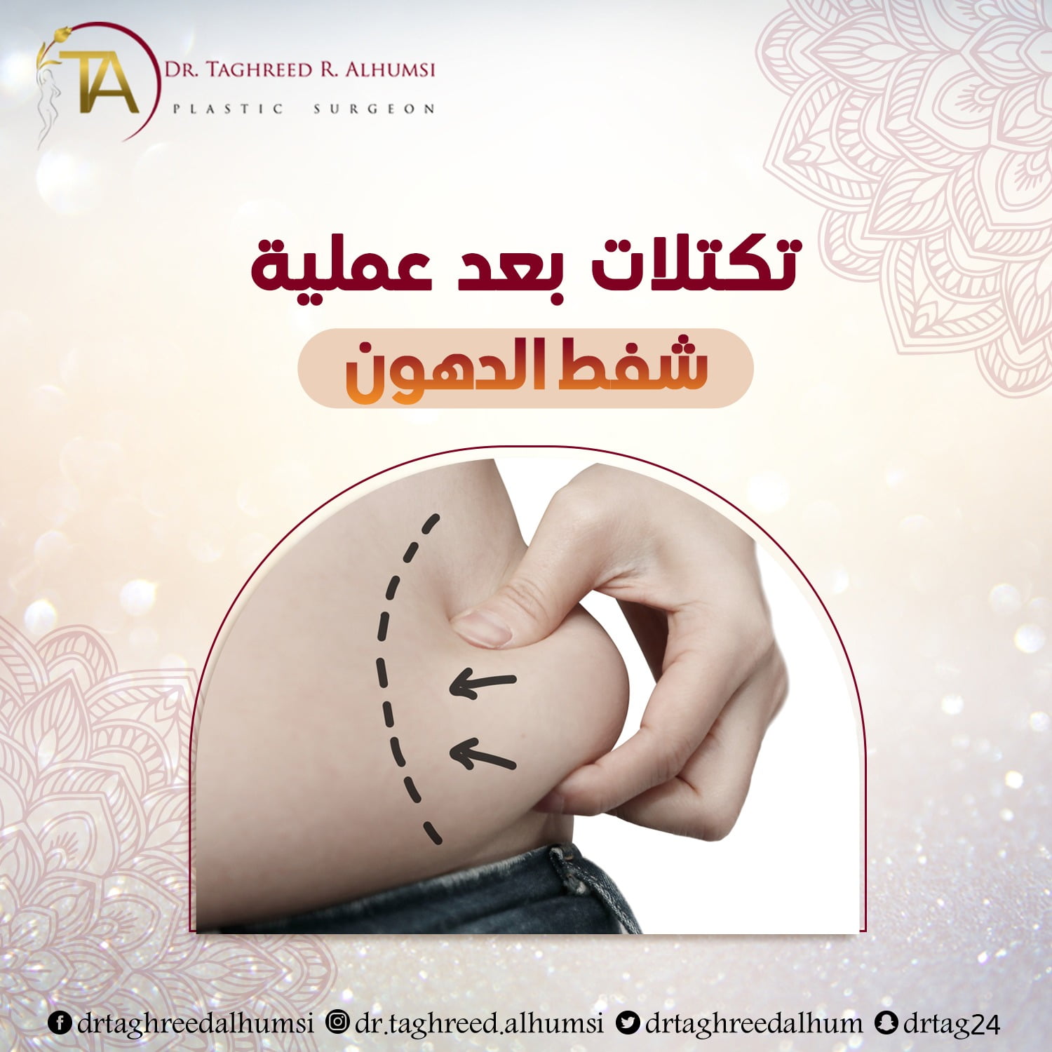 تكتلات بعد عملية شفط الدهون