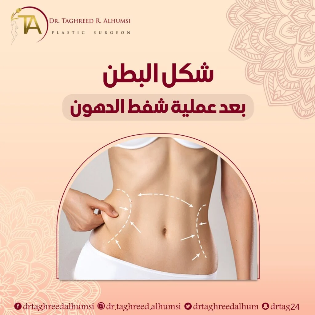 شكل البطن بعد عملية شفط الدهون