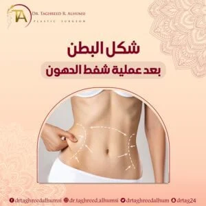 شكل البطن بعد عملية شفط الدهون