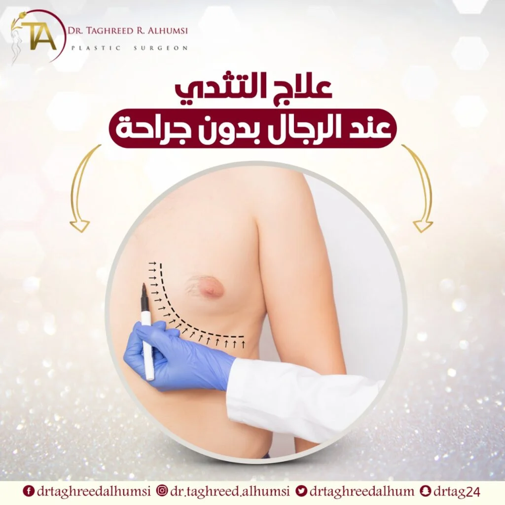 علاج التثدي عند الرجال