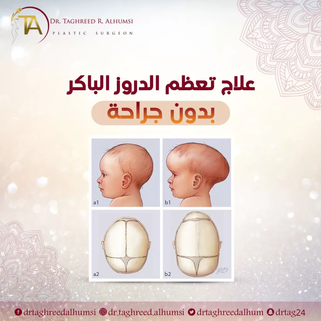 علاج تعظم الدروز الباكر بدون جراحة