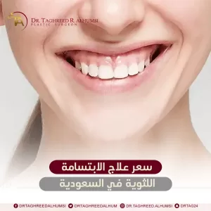 سعر علاج الابتسامة اللثوية في السعودية 