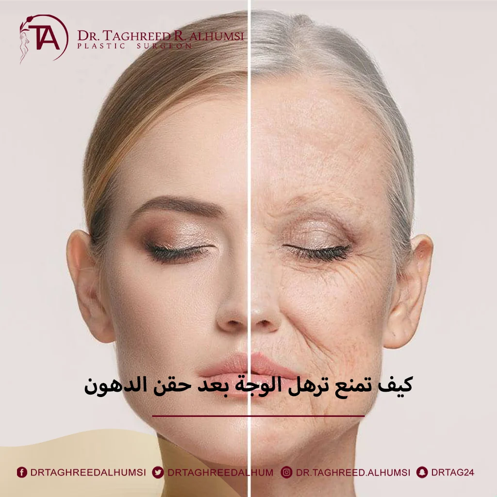 ترهل الوجه