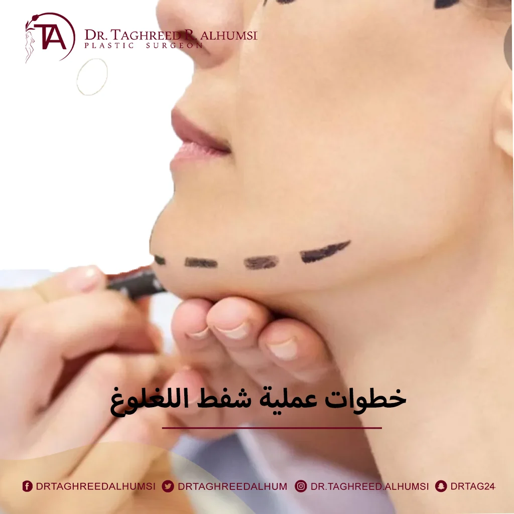 عملية شفط اللغلوغ 