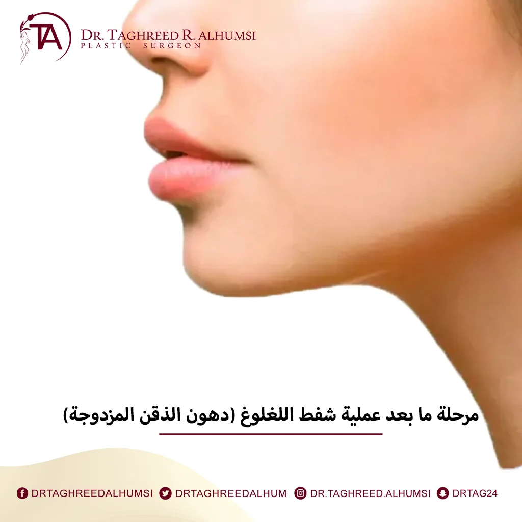 مرحلة ما بعد عملية شفط اللغلوغ 