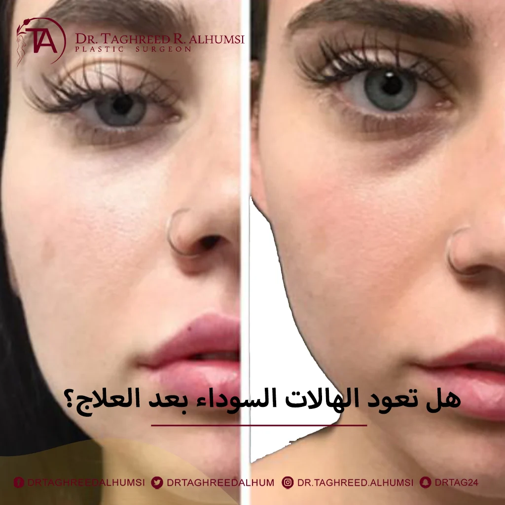 الفلير للهالات السوداء