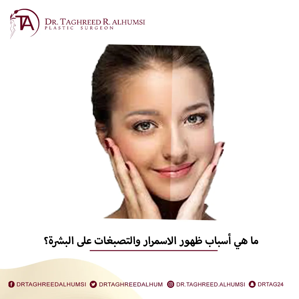 اسباب إزالة اسمرار البشرة والتصبغات