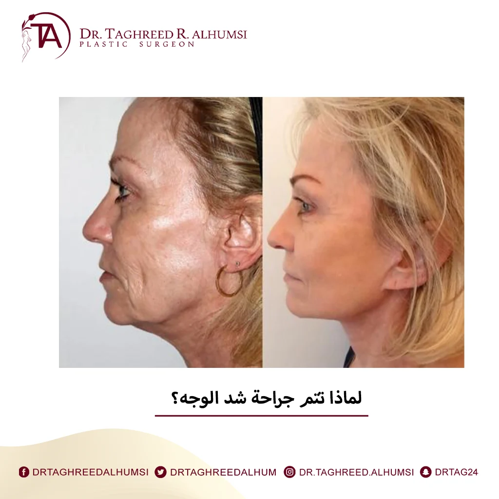 لماذا تتم جراحة شد الوجه؟