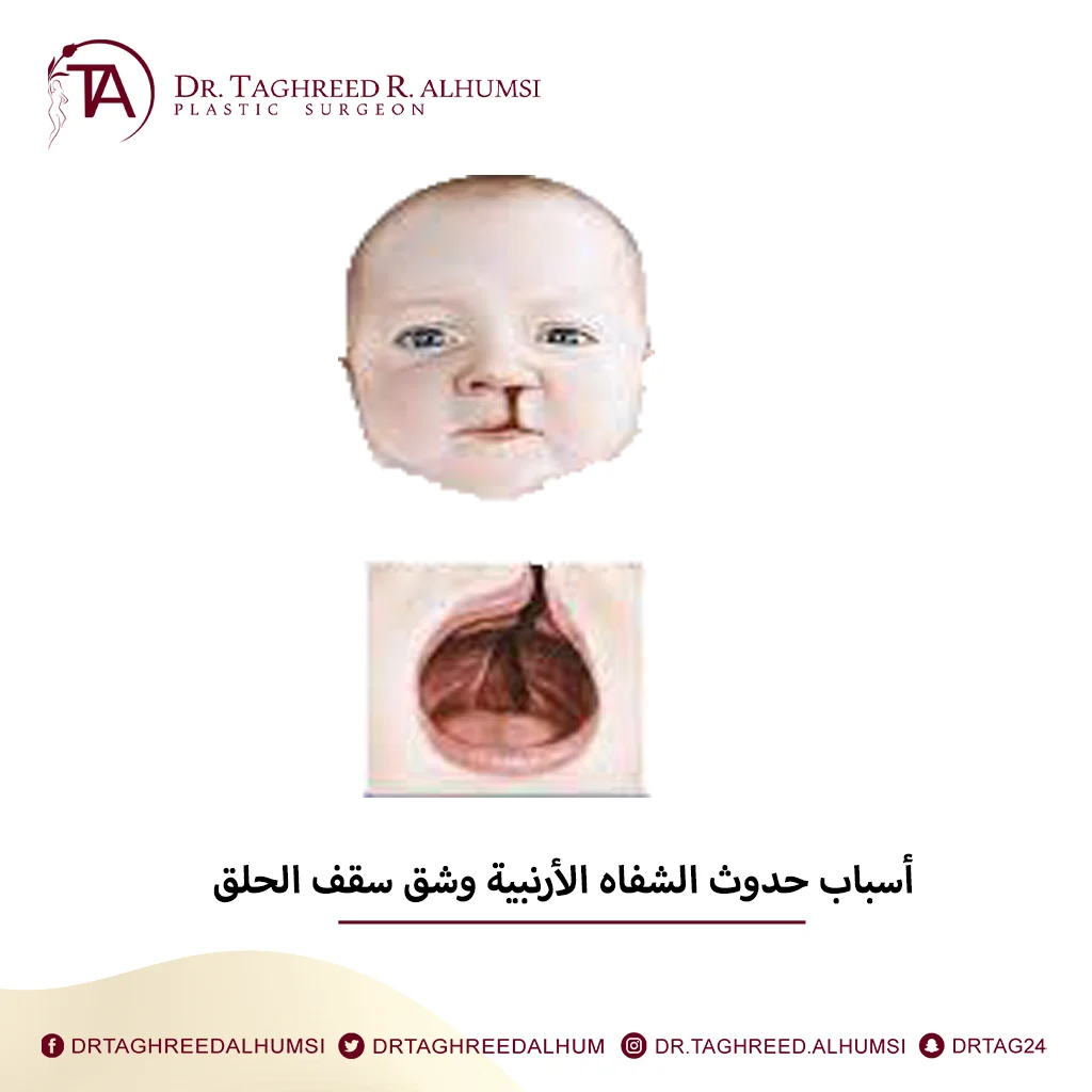  اصلاح الشفاه الأرنبية 