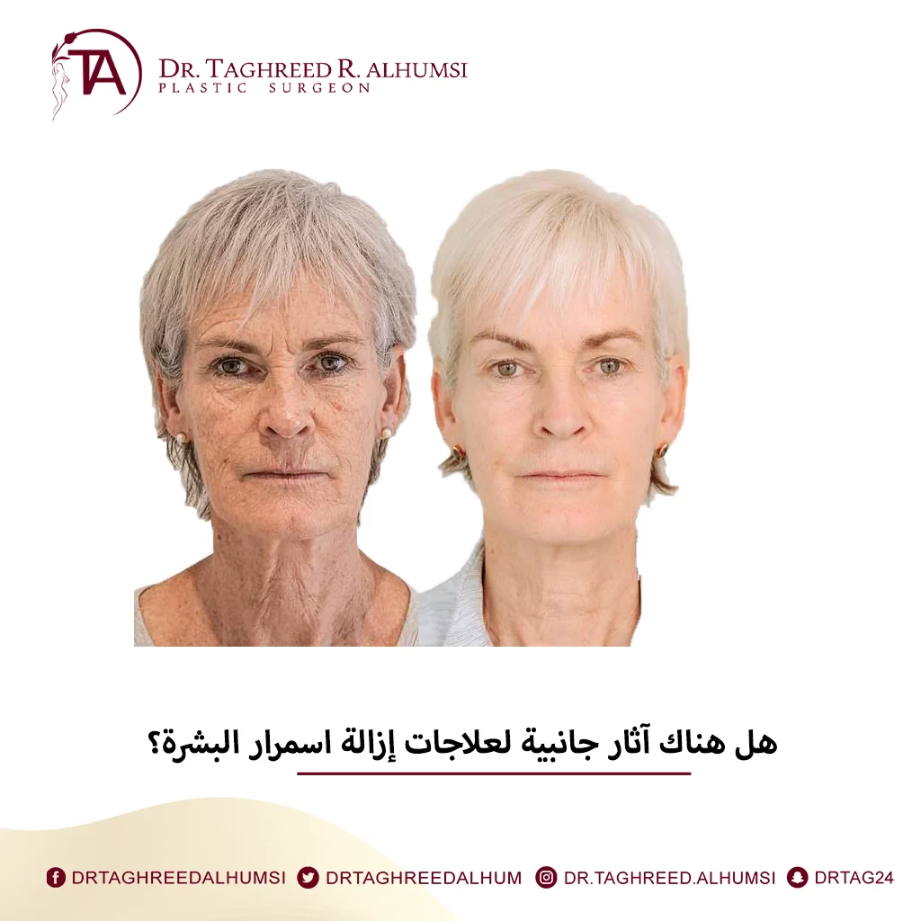 إزالة اسمرار البشرة والتصبغات