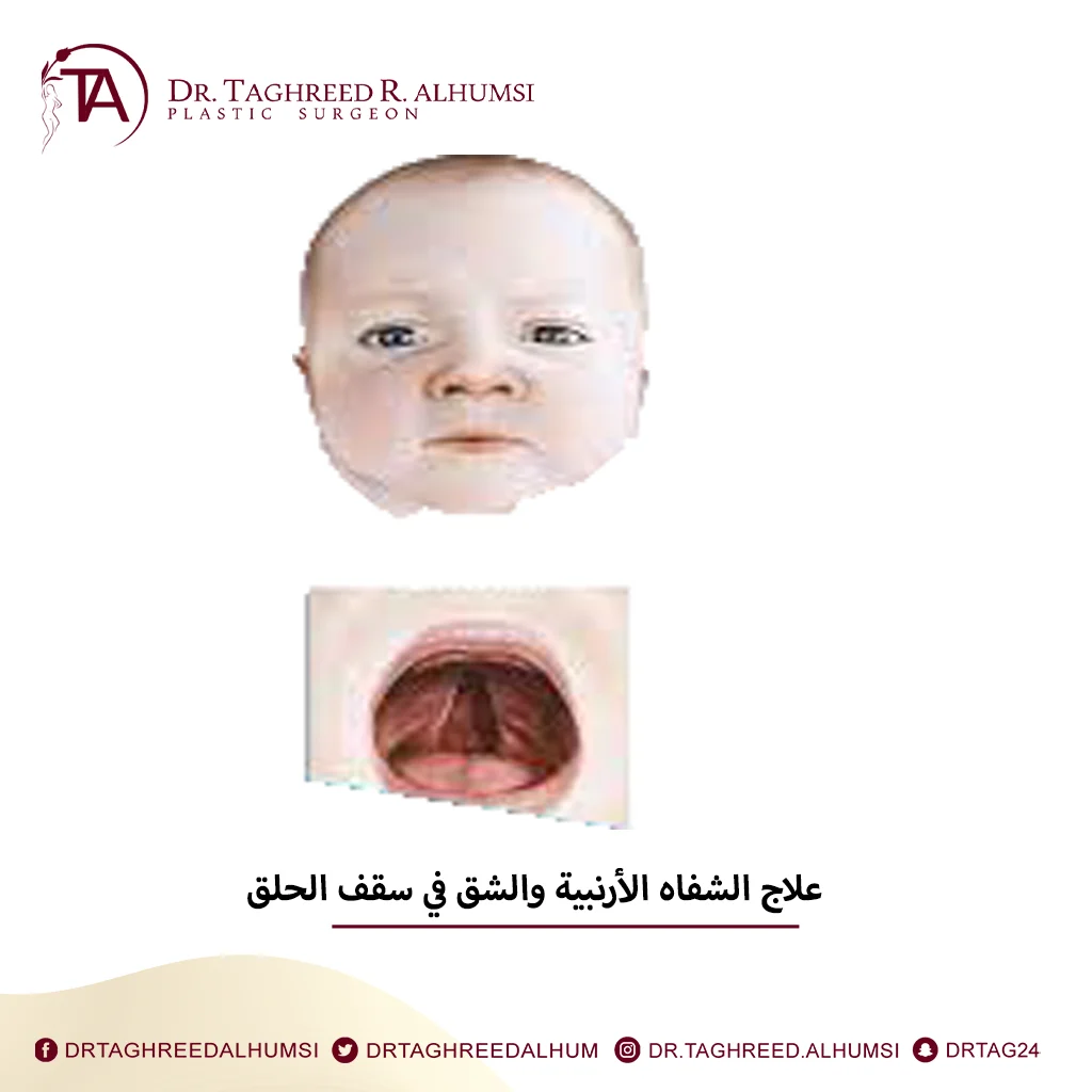 جراحة اصلاح الشفاه الأرنبية وشق سقف الحلق