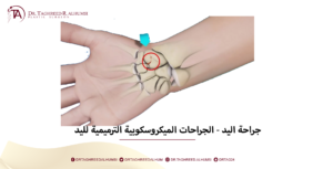 جراحة اليد - الجراحات الميكروسكوبية الترميمية لليد