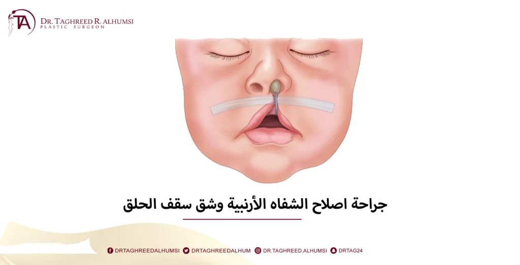 جراحة اصلاح الشفاه الأرنبية وشق سقف الحلق