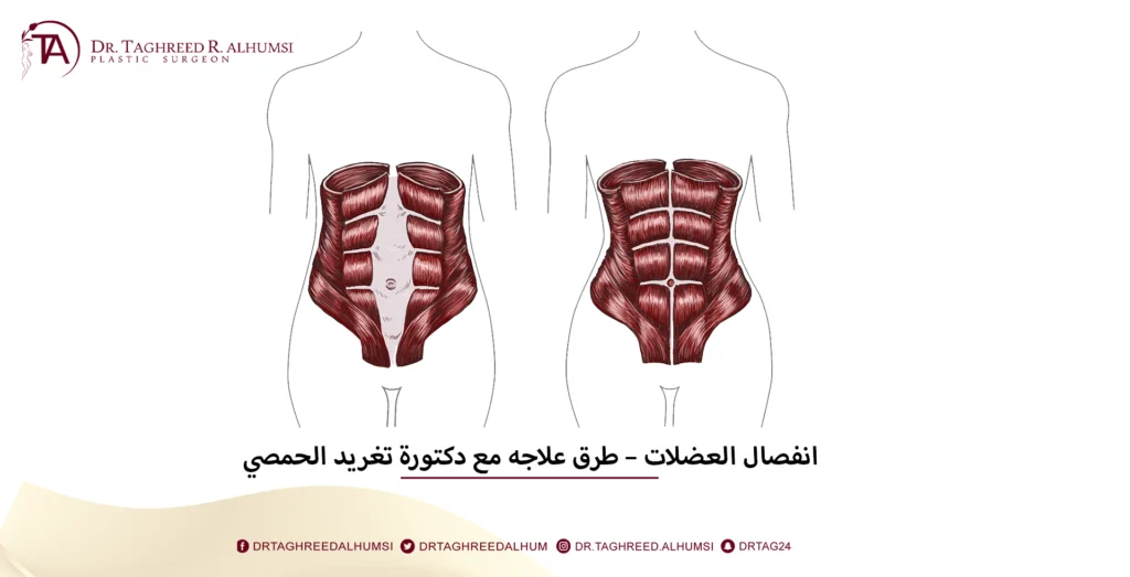 انفصال العضلات