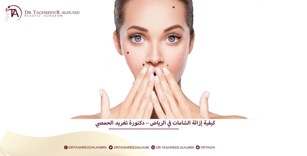 ازالة الشامات