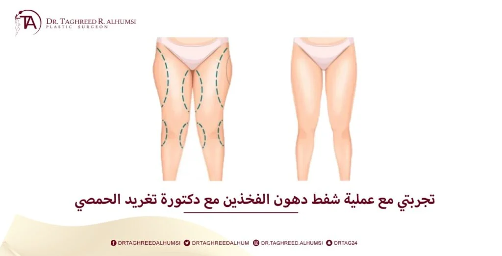 شفط دهون الفخذين