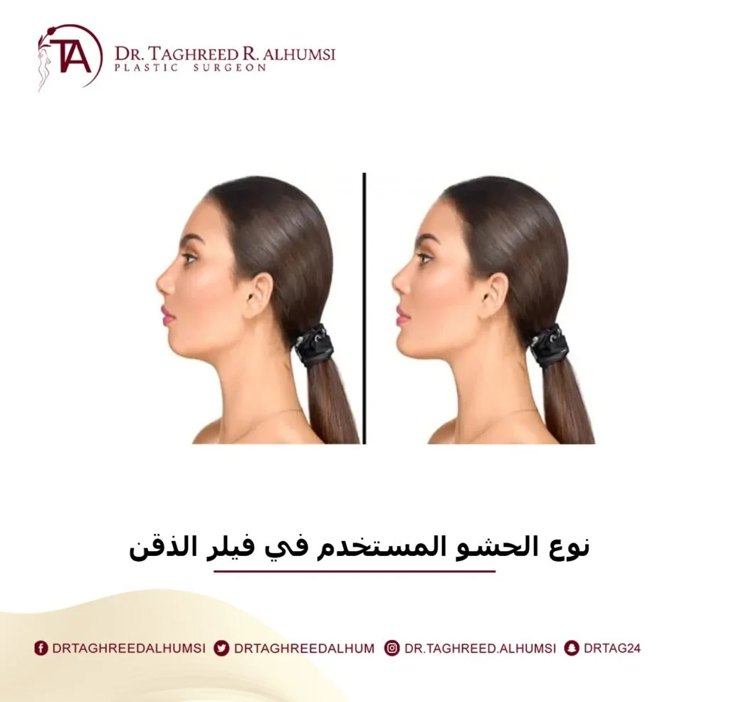 فيلر الذقن