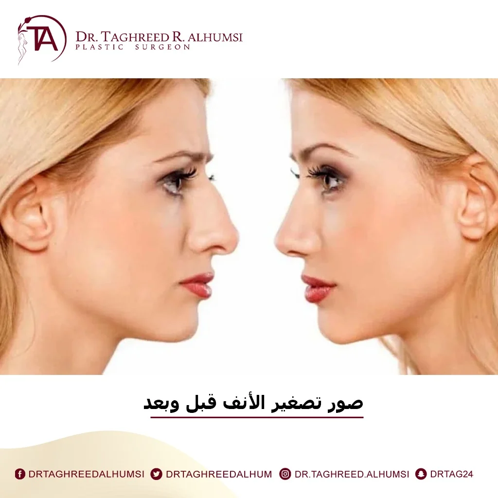 تصغير فتحات الأنف في الرياض – دكتورة تغريد الحمصي