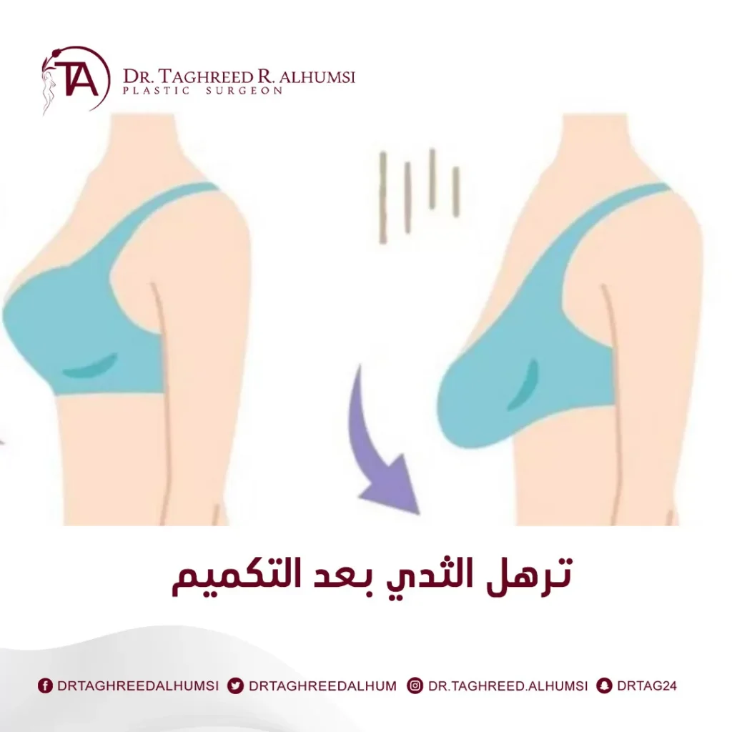 درجات ترهل الثدي