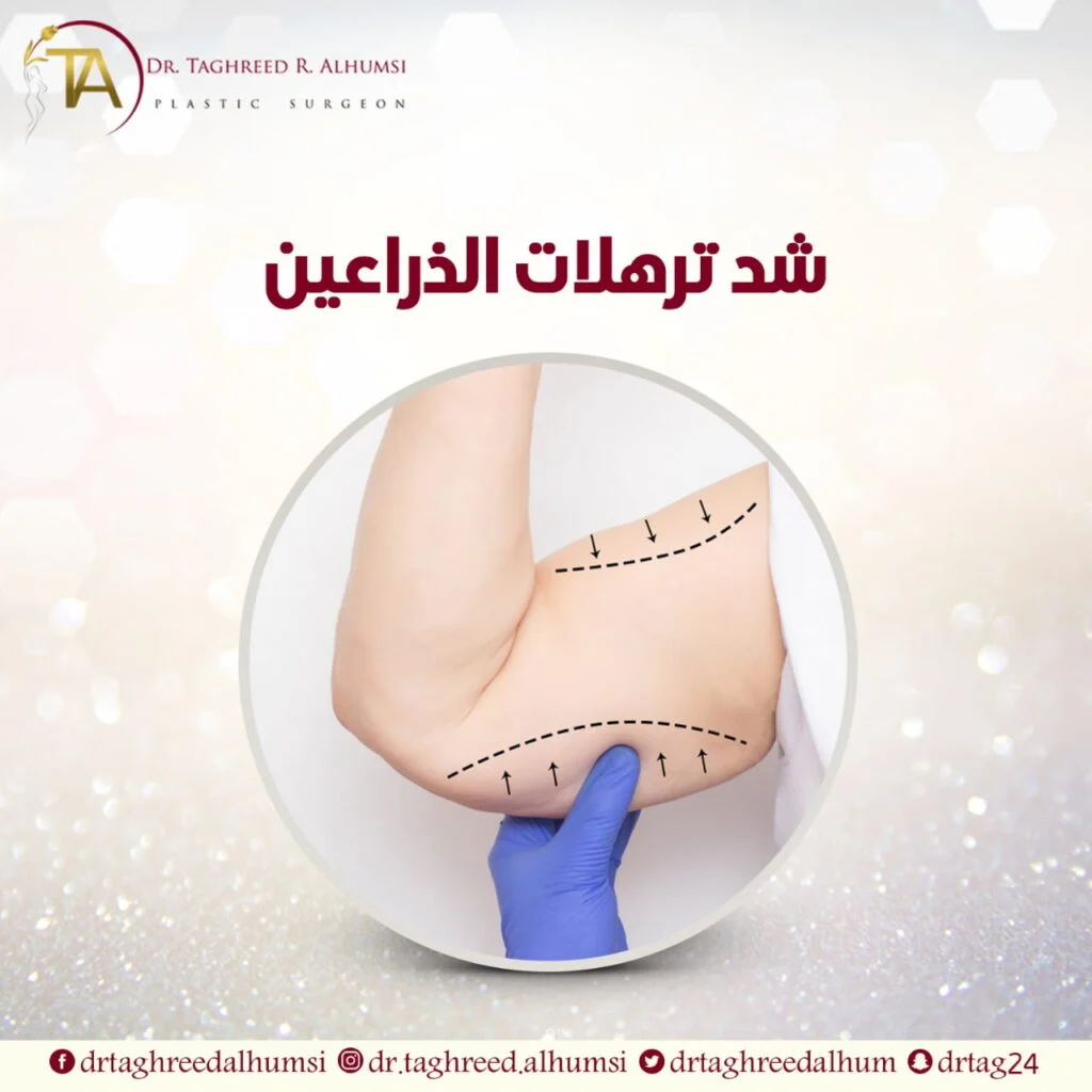 أفضل دكتورة شد وشفط الذراعين بعد التكميم