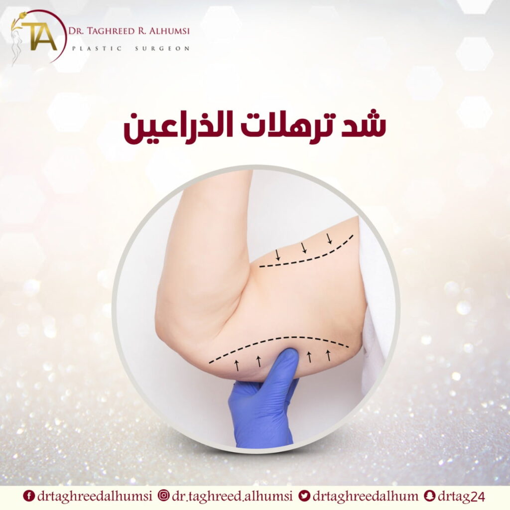 أفضل دكتورة شد وشفط الذراعين بعد التكميم
