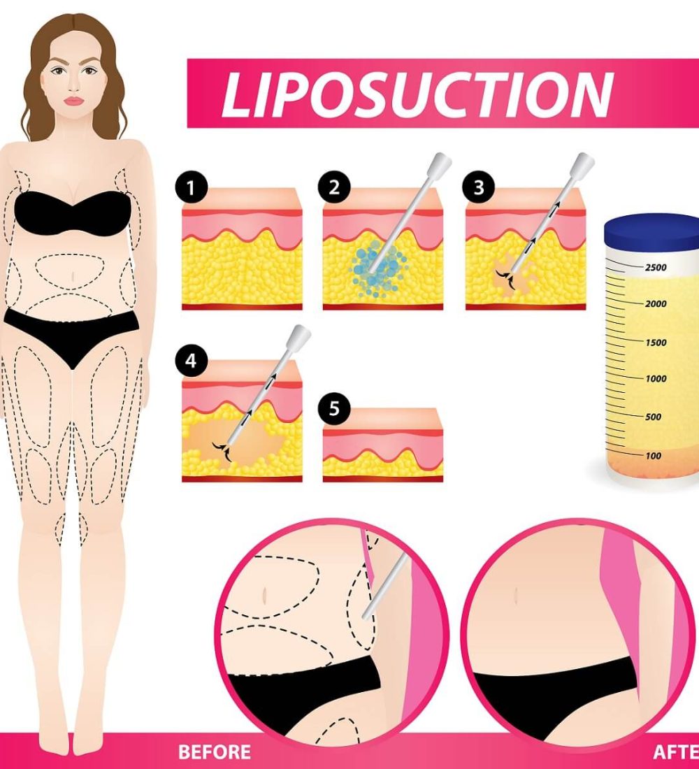 liposuction-1